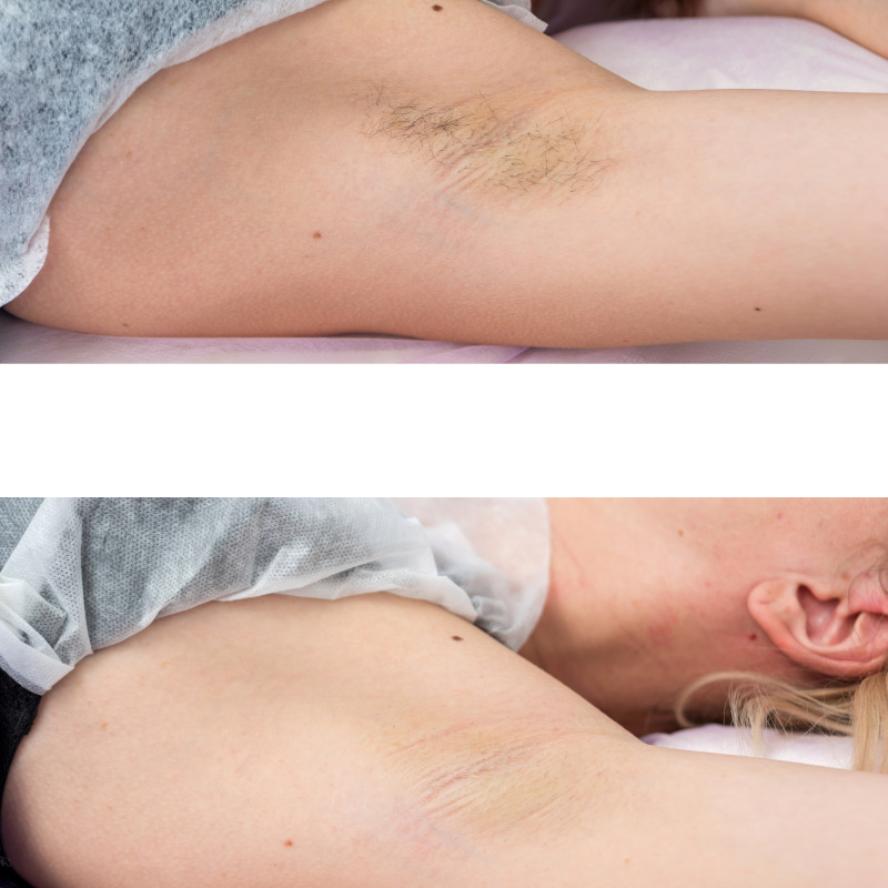 Laser Hair Removal